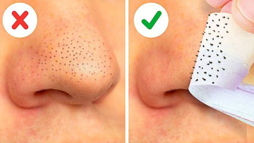 Ủ Mũi Xử Lý Mụn Đầu Đen Remove Blackheads Hàn Quốc 50ml